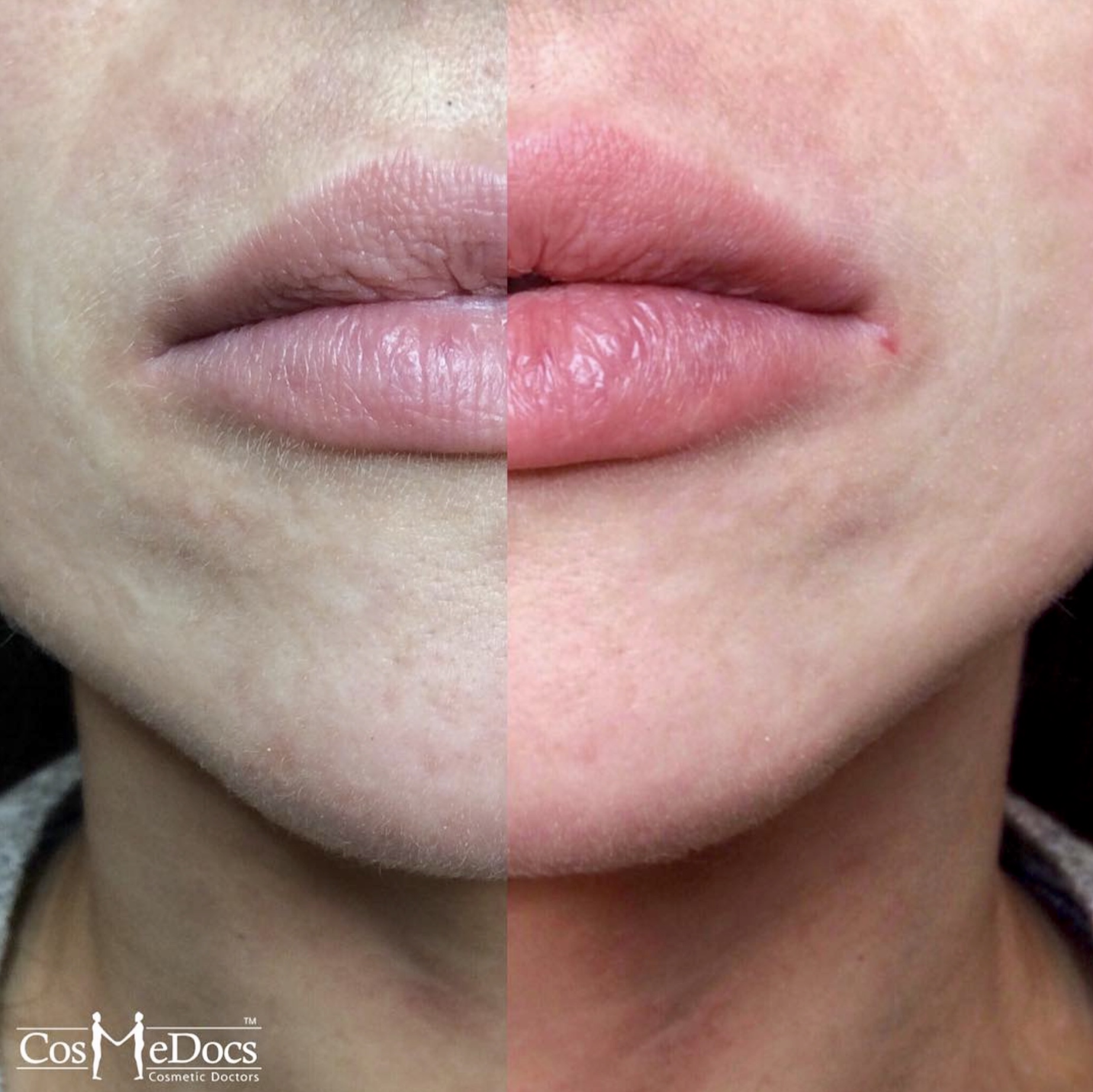 Lip enhancement before and after dermal filler treatment