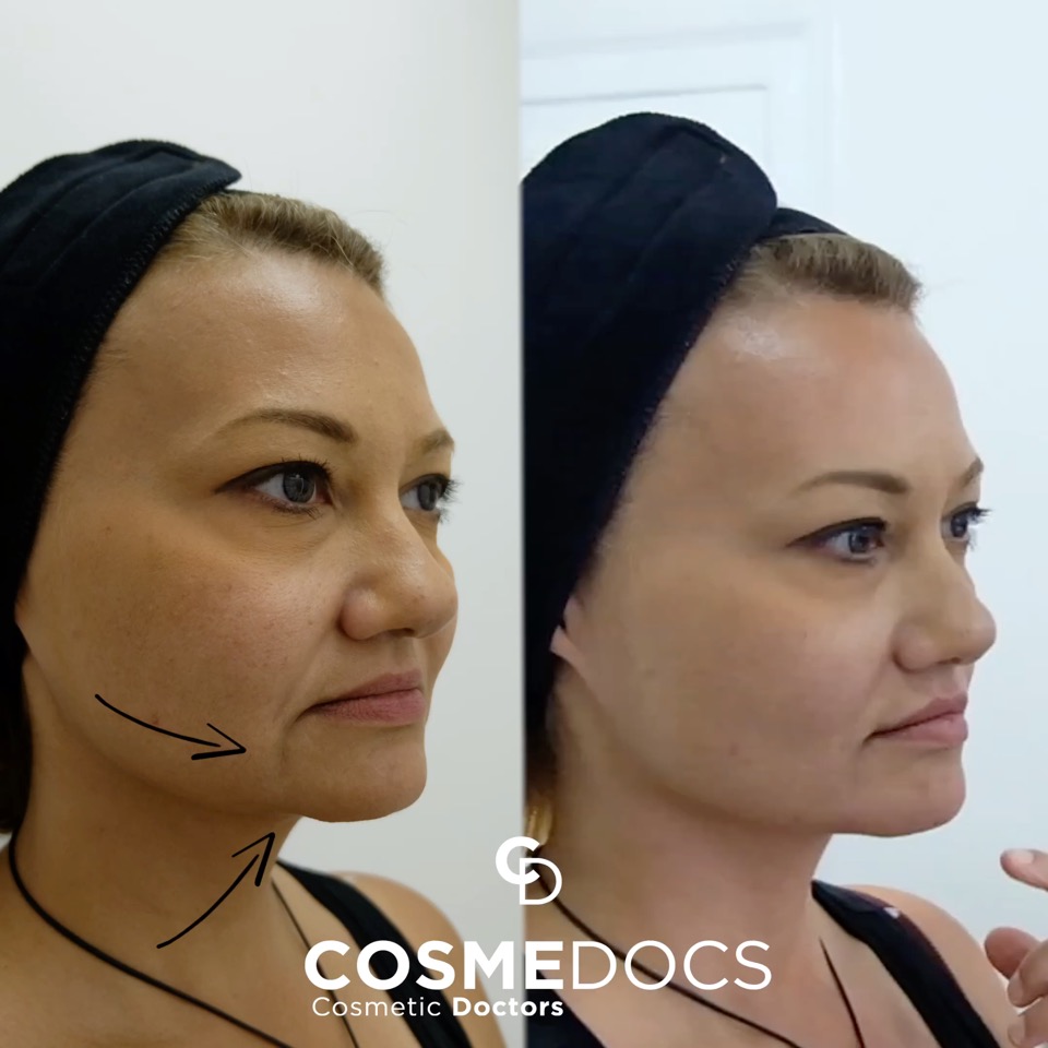 Marionette lines before and after dermal filler treatment
