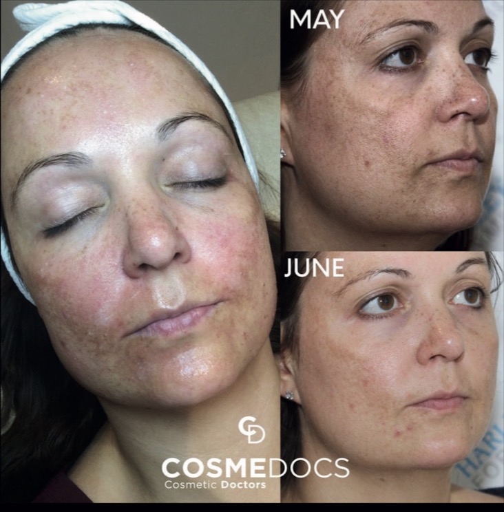 Mixed peel and microneedling treatment results