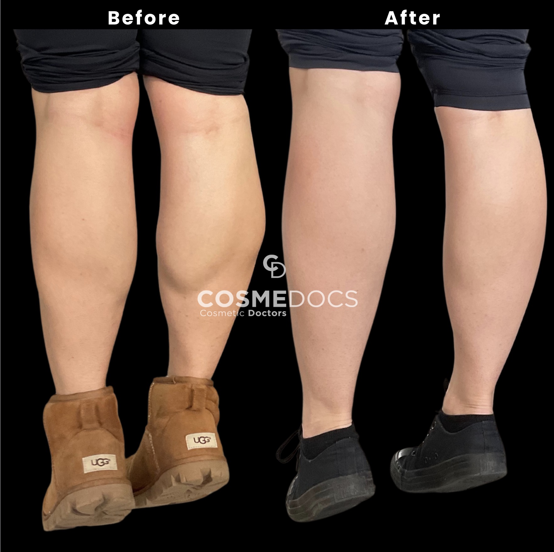 伦敦小腿肌肉减少肉毒杆菌治疗效果