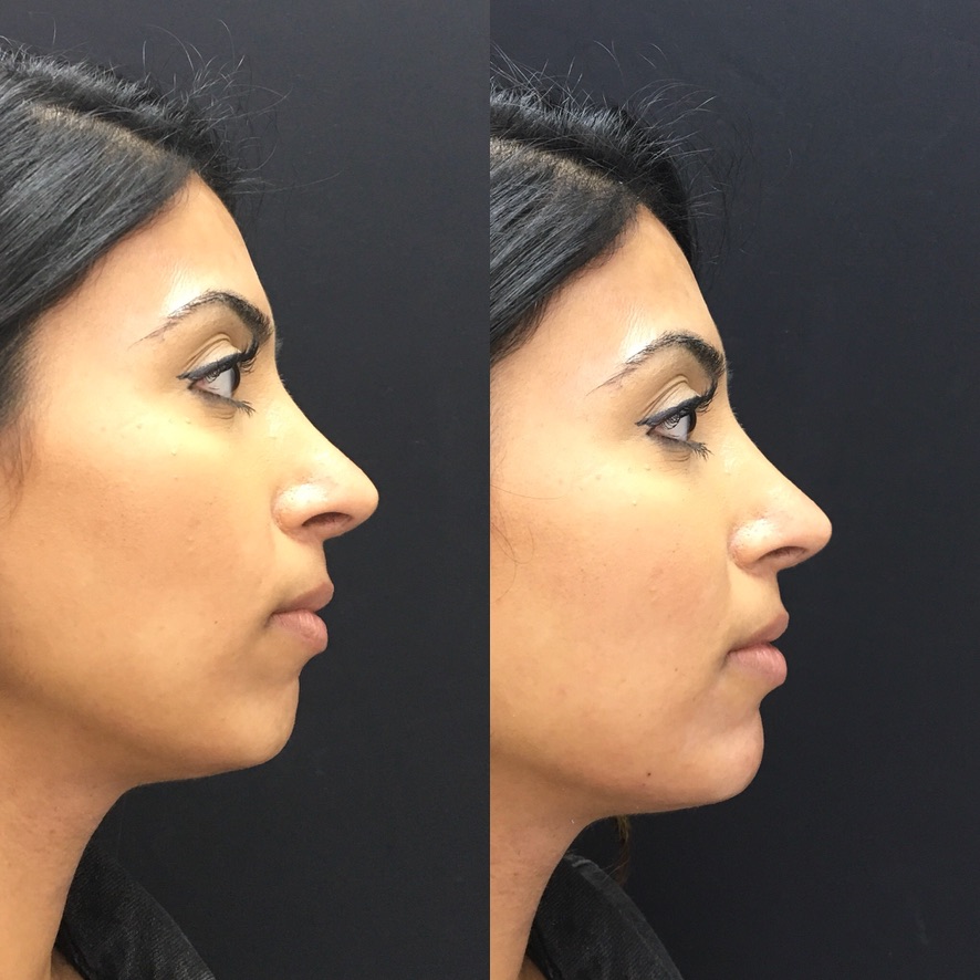 Non-surgical nose reshaping profile botox London Harley Street results