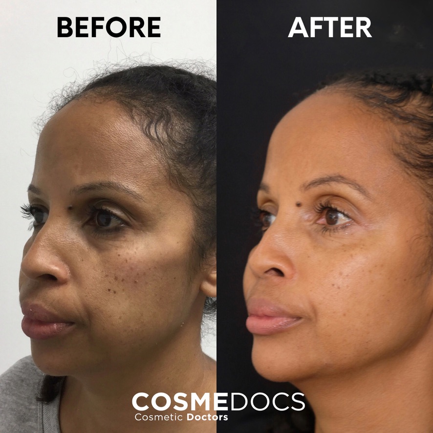 Dermal filler makeover before and after side profile