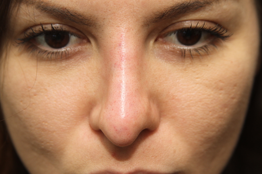 After deviated nose correction London Harley Street Cosmedocs results