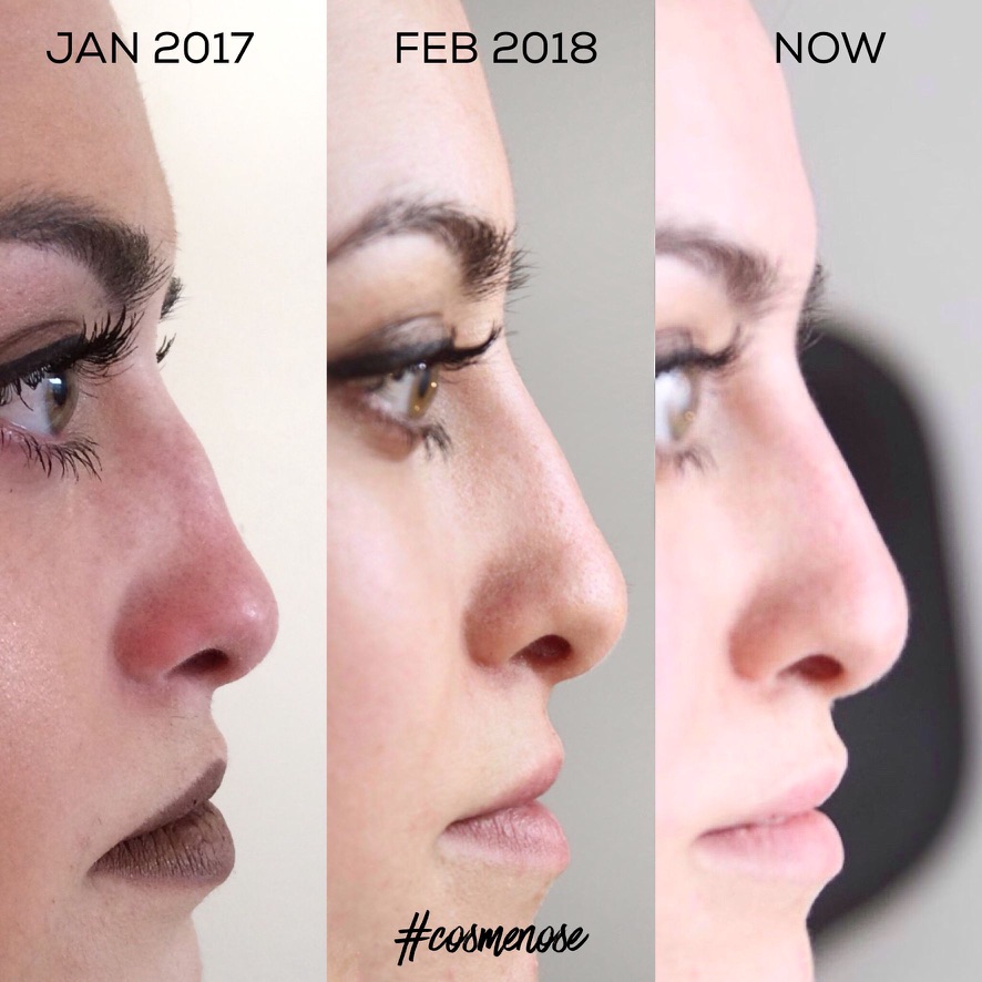 Non-surgical nose job 3 year progression London Harley Street botox filler results
