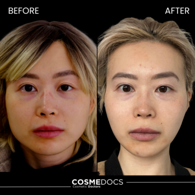 Masseter Botox before and after showing facial slimming results