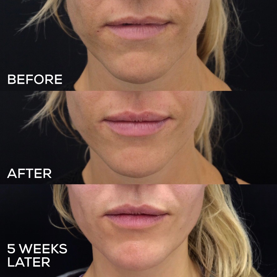Before and after 1ml lip filler progression showing immediate results and healed after 5 weeks