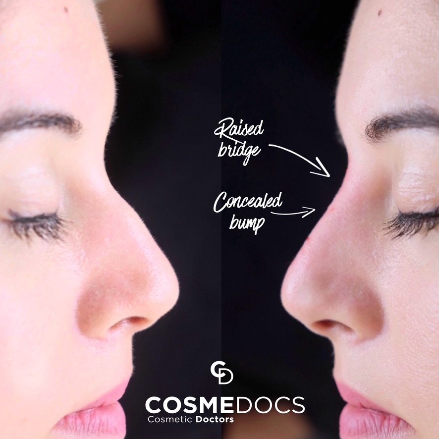 Bridge bump correction liquid nose job London Harley Street Cosmedocs