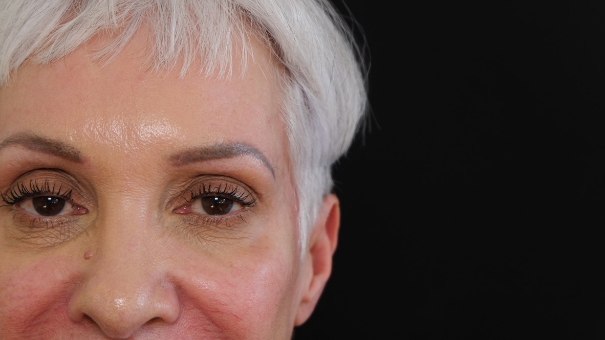 Temple filler results immediately after treatment showing restored volume and improved facial harmony