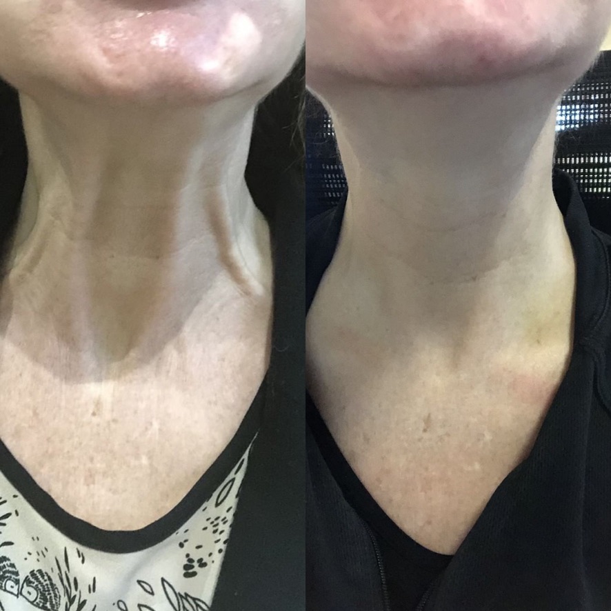 Nefertiti Lift before and after results showing improved neck contour