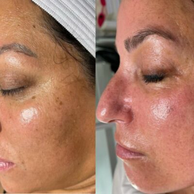 HydraFacial skin hydration before after London Cosmedocs glowing results