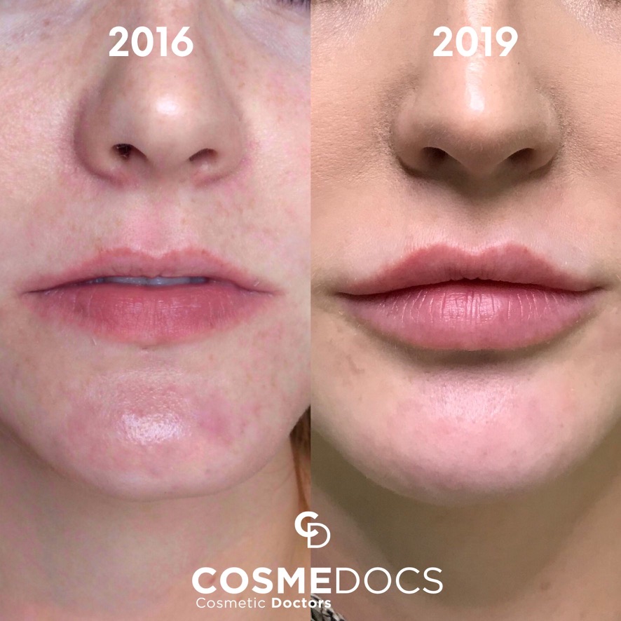 Before and after 0.5ml lip filler London showing natural lip augmentation progression over 3 years