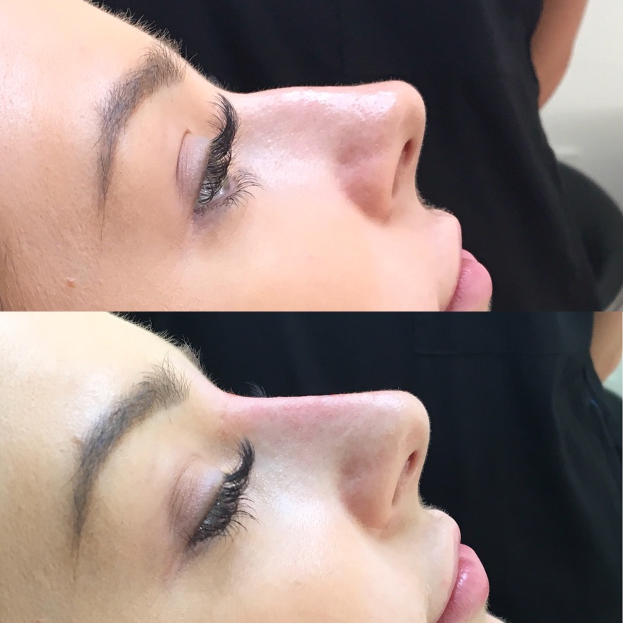 Non-surgical nose job profile comparison botox London Cosmedocs Harley Street