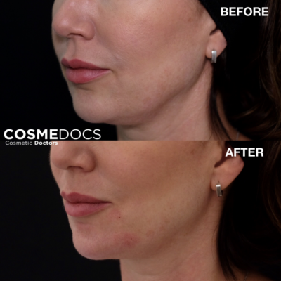 Chin filler profile enhancement side view transformation Harley Street