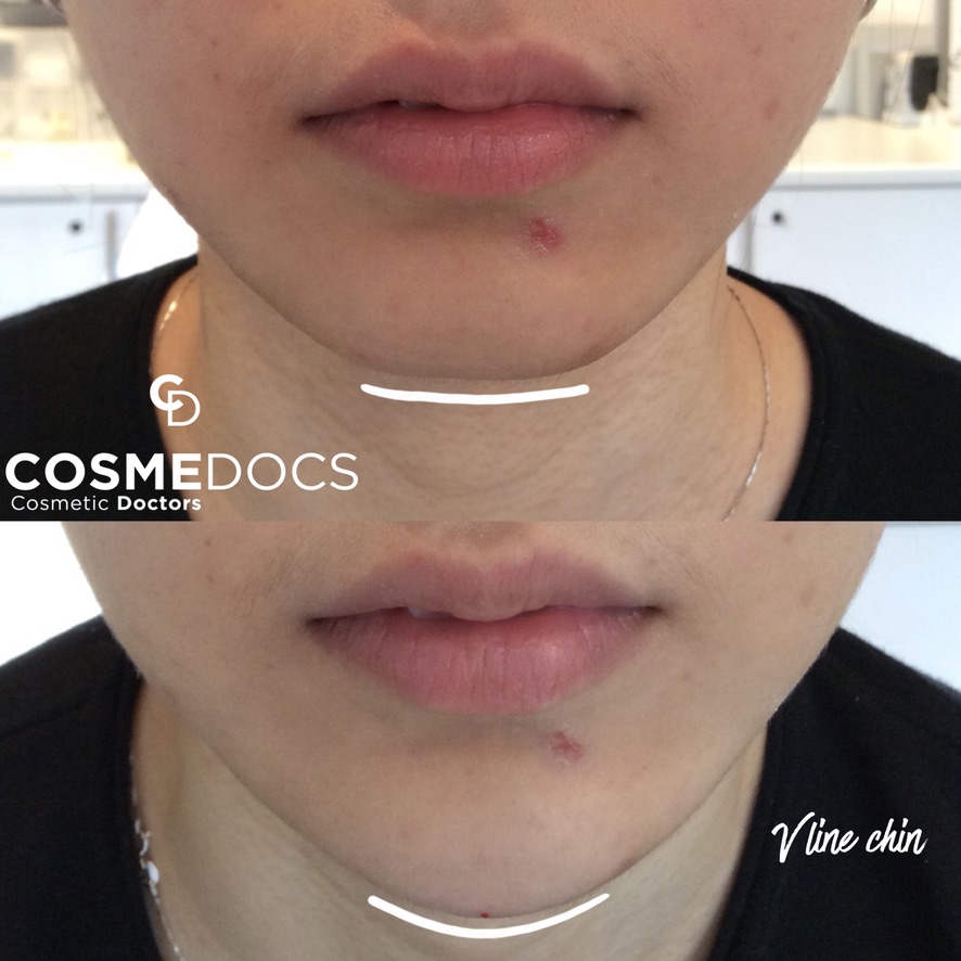 V-Line chin contouring treatment to complement botox dimpled chin