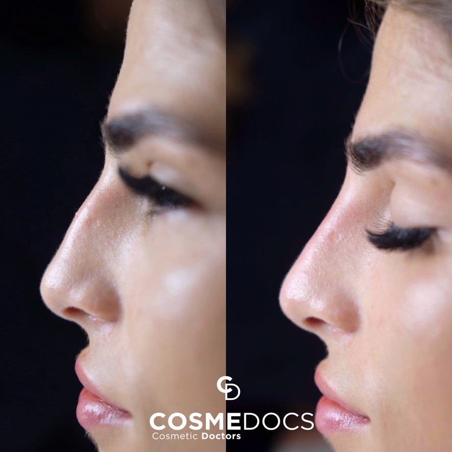 Non-surgical rhinoplasty before after London Harley Street Dr Ahmed Haq