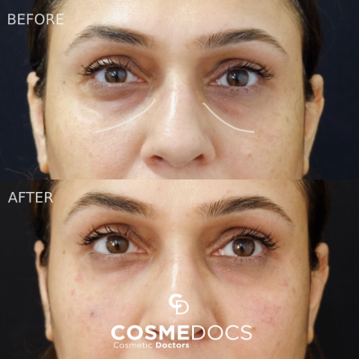 Tear trough filler before and after transformation