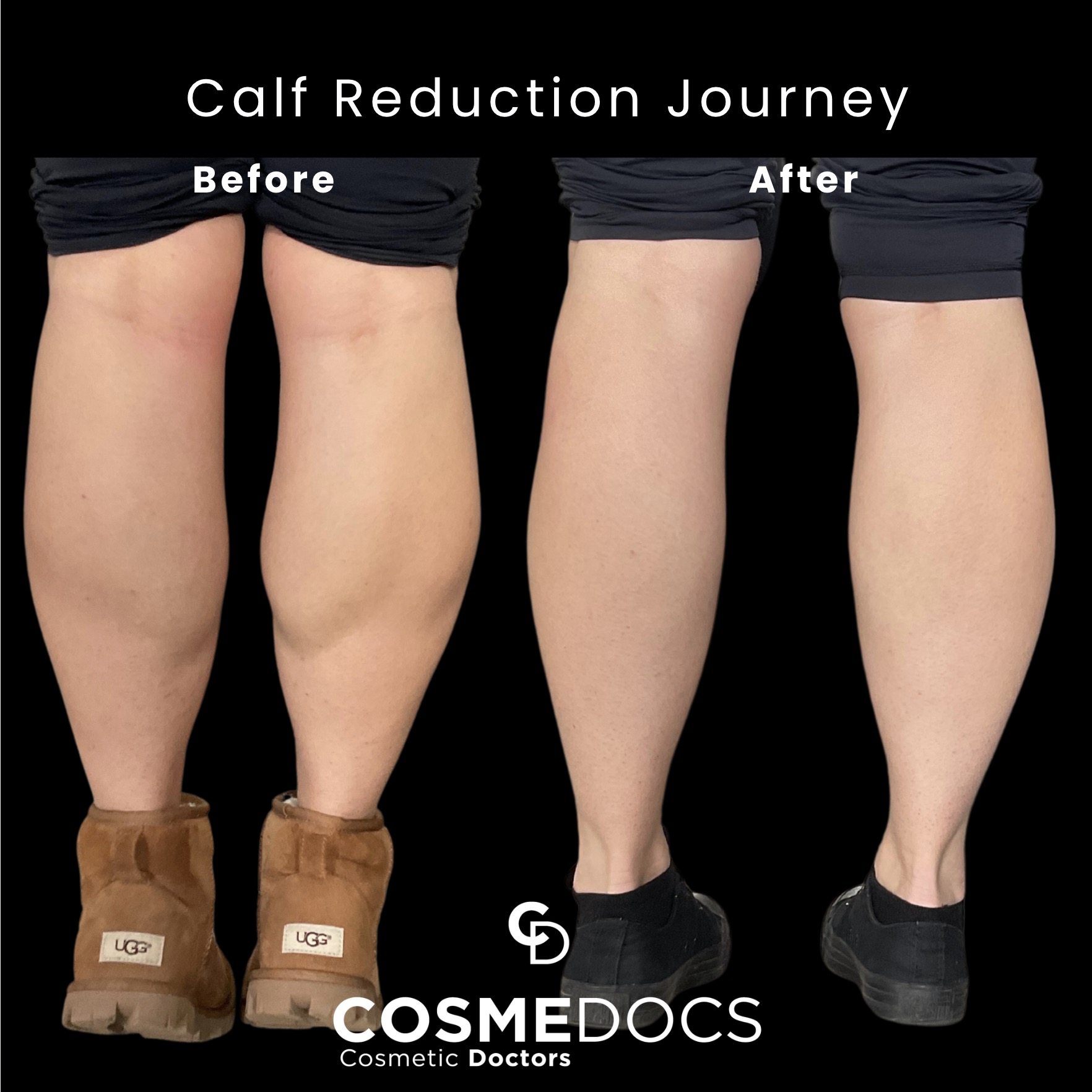 肉毒杆菌瘦小腿前后对比显示精致腿部轮廓