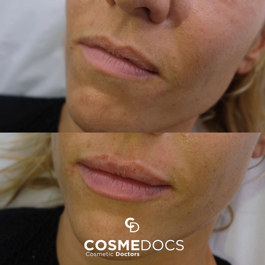 Before and after 0.5ml lip filler natural looking lip enhancement London treatment