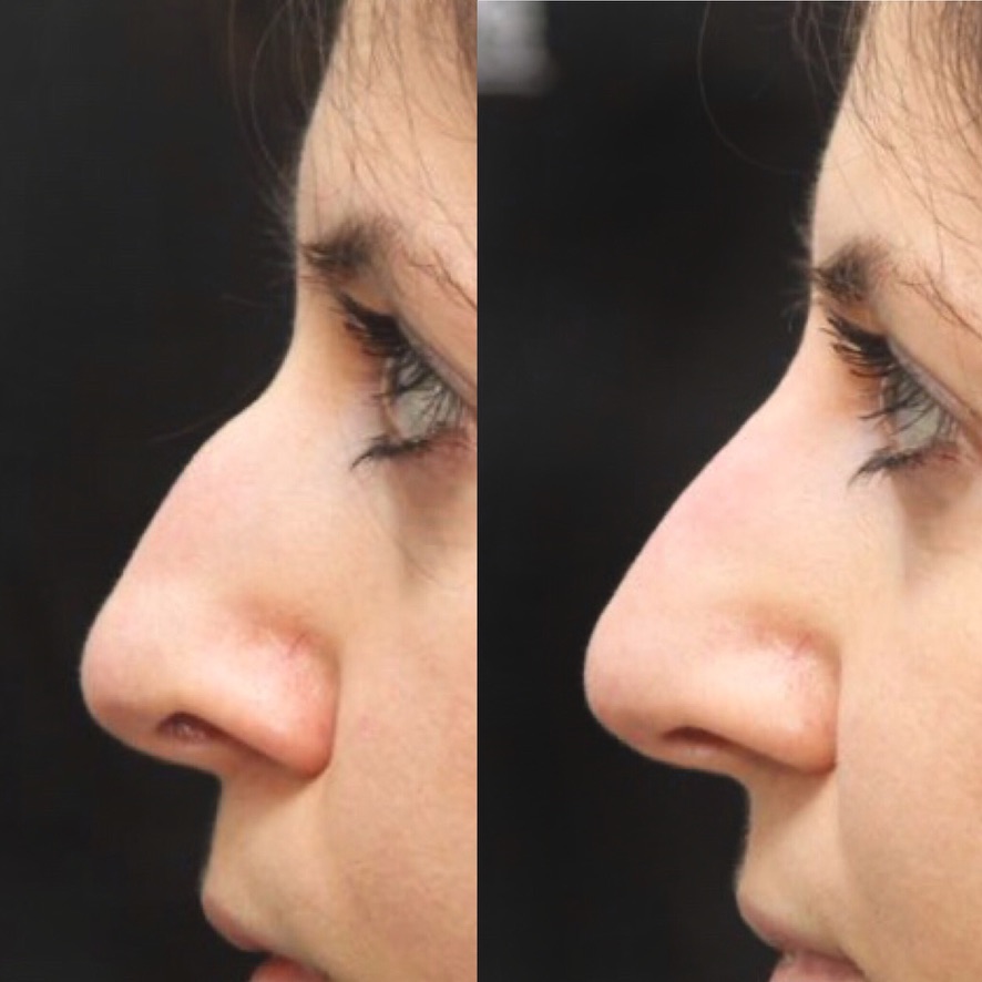 Non-surgical nose job profile pixie tip filler London Harley Street