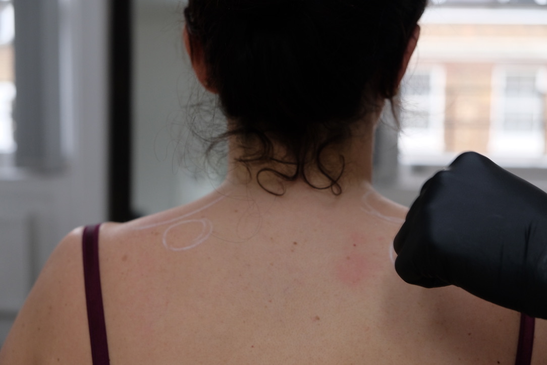 Professional trigger point injection procedure London - expert practitioner administering botox injection for chronic muscle pain and myofascial tension relief