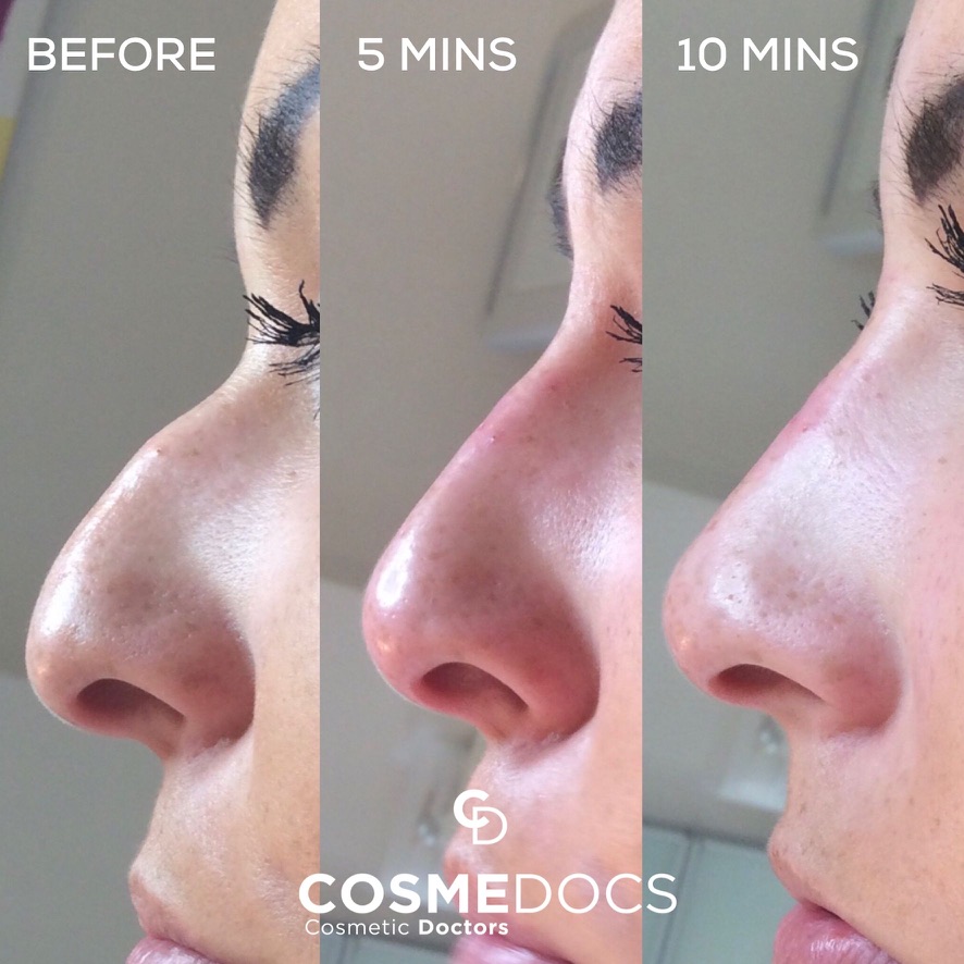 Nose filler treatment progression nonsurgical rhinoplasty London Harley Street