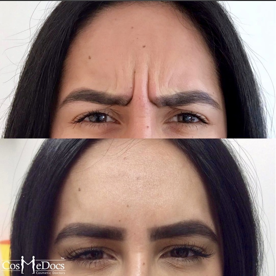 Best botox London before and after results for frown lines at Cosmedocs Harley Street clinic