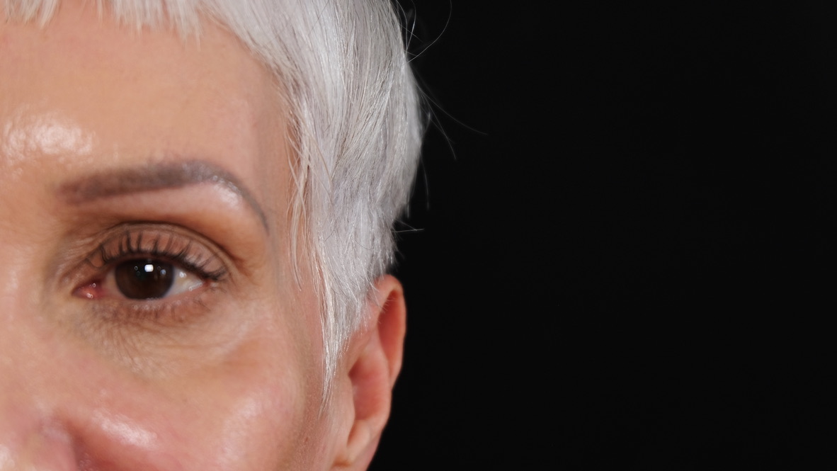 Temple area before filler injection showing natural aging process and volume depletion