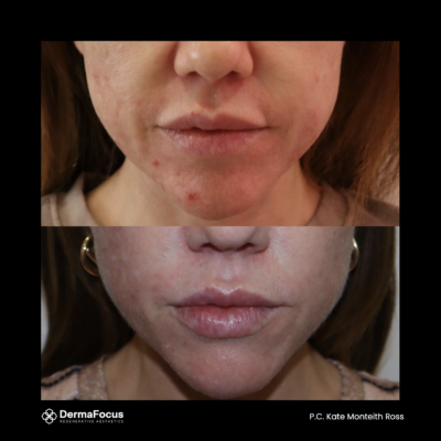 Polynucleotide treatment London lip rejuvenation results showing enhanced texture and reduced fine lines