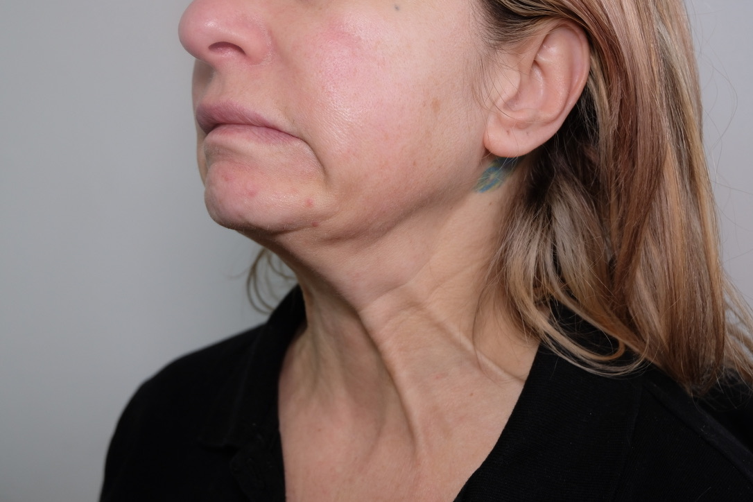 Nefertiti Lift side profile showing enhanced jawline definition