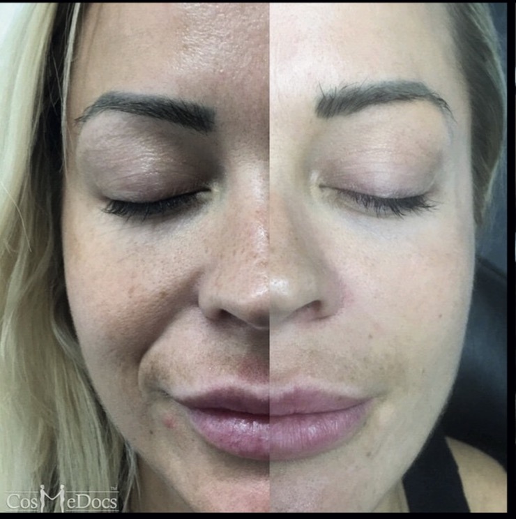 Microneedling before and after results