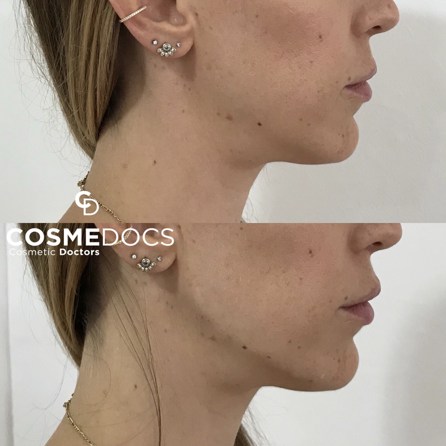 Dermal filler makeover side profile enhancement