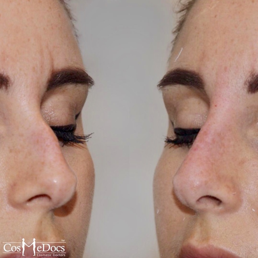 Nose reshaping before and after non-surgical rhinoplasty
