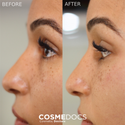 Complete under eye makeover