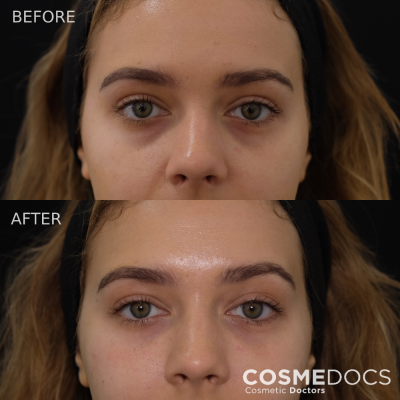Tear trough rejuvenation results