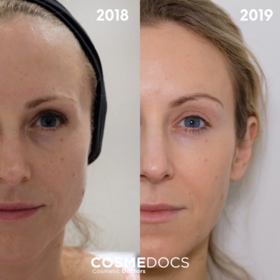 Masseter Botox progression 2018 to 2019